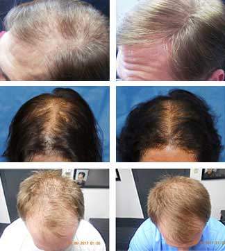 womens hair loss replacement systems appleton wisconsin